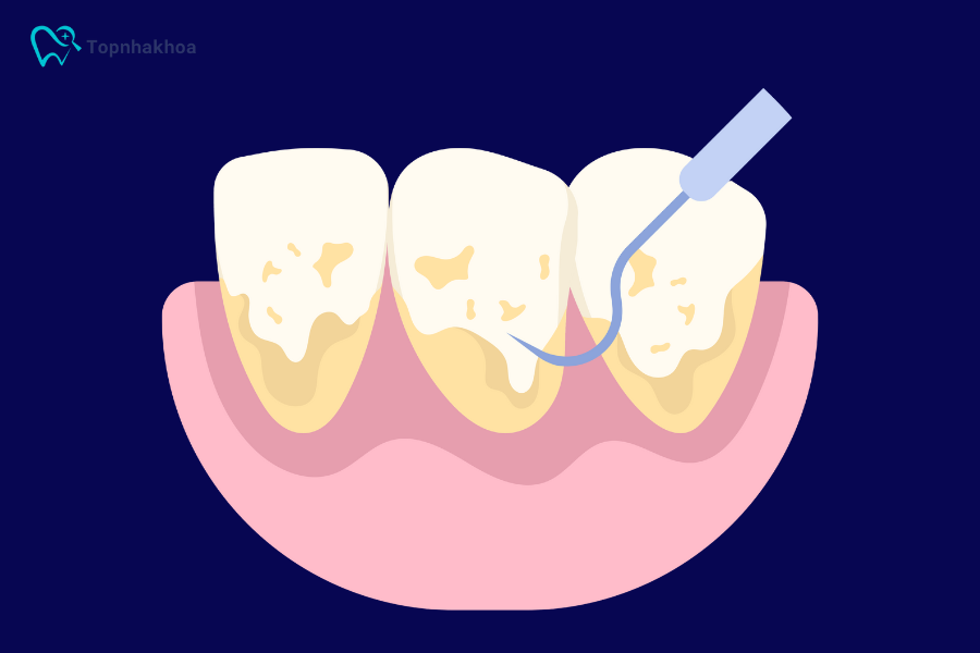Hướng dẫn tự lấy cao răng tại nhà an toàn và hiệu quả Với các phương pháp an toàn, dễ thực hiện ngay tại nhà và nguyên liệu sẵn có, bạn hoàn toàn có thể làm sạch mảng bám hiệu quả