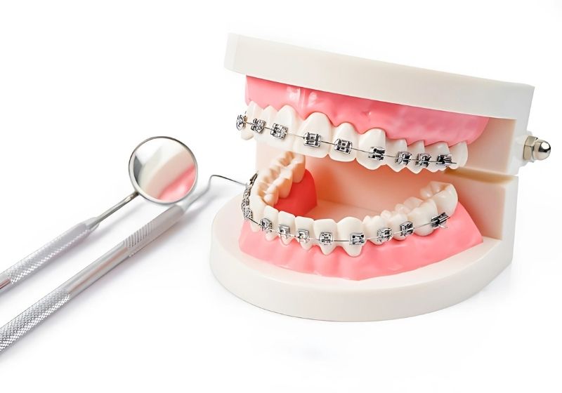 Trang bị đầy đủ kinh nghiệm giúp quá trình niềng răng diễn ra an toàn, hiệu quả
