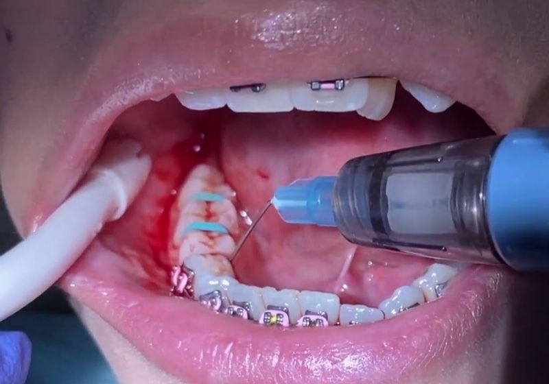 Vệ sinh kém khi niềng răng dễ gây viêm nướu và chảy máu chân răng