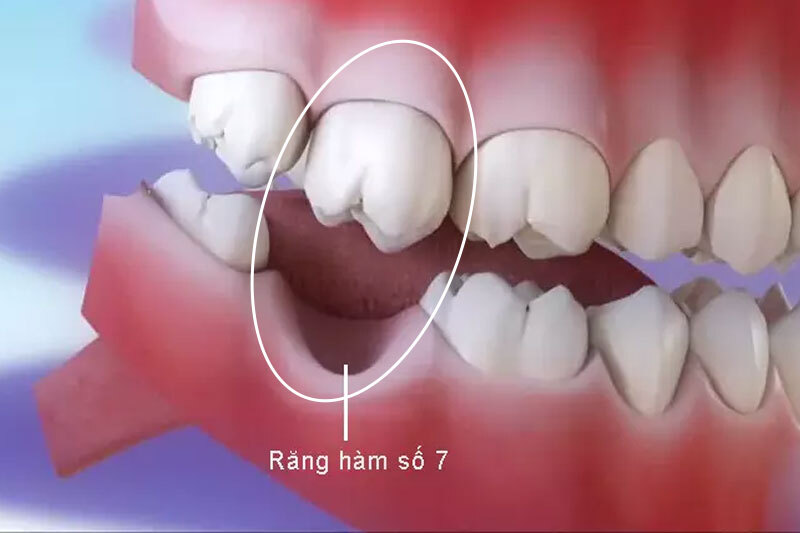 Mất răng có niềng được không? Khi nào nên niềng Mất răng số 7 vẫn có thể niềng răng nếu răng số 6 còn khỏe.