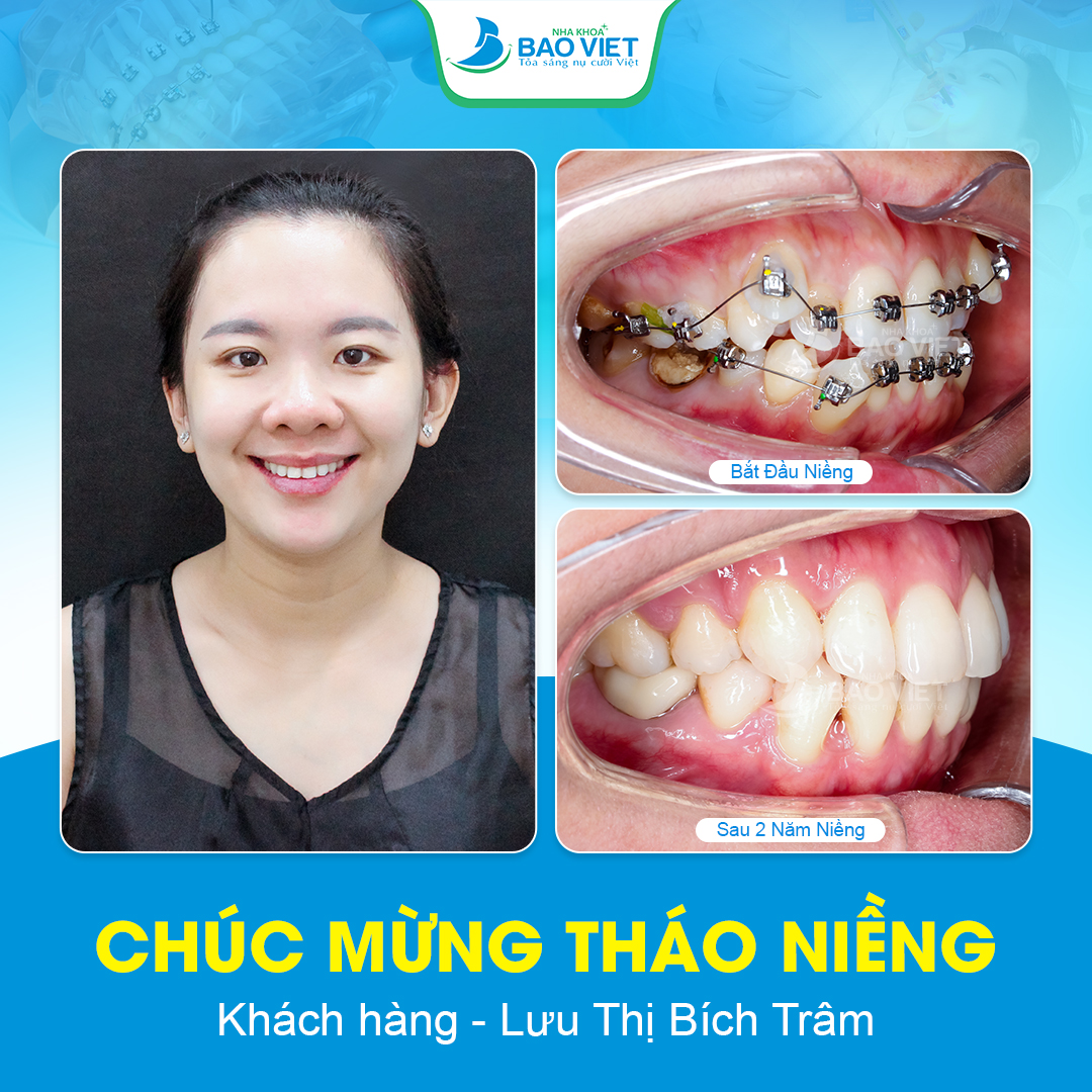 Nha khoa Bảo Việt tận tâm hết mình vì quyền lợi khách hàng Chị Trâm sở hữu hàm răng đều tăm tắp, thẳng hàng và khớp cắn chuẩn chỉnh sau 2 năm điều trị tại Bảo Việt