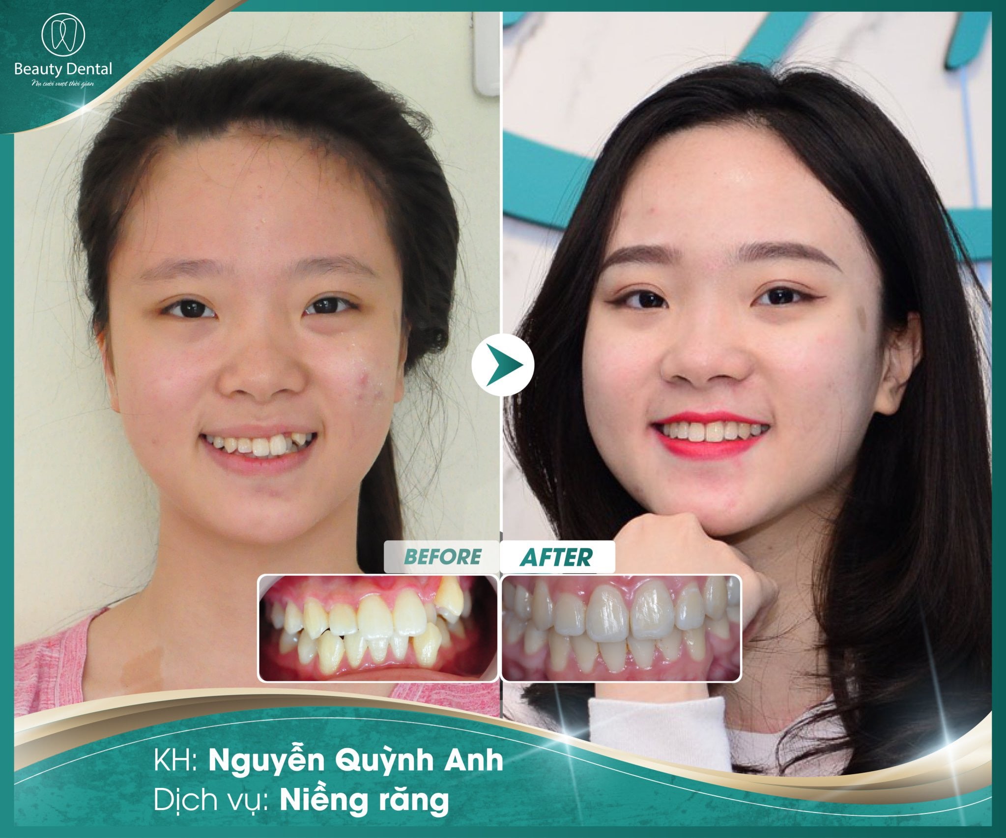 Sau tháo niềng Quỳnh Anh sở hữu hàm răng đều tăm tắp, khớp cắn chuẩn và gương mặt hài hòa