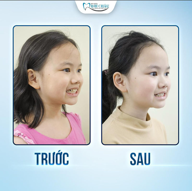 Sau điều trị bé Thỏ sở hữu hàm răng đều và đẹp hơn