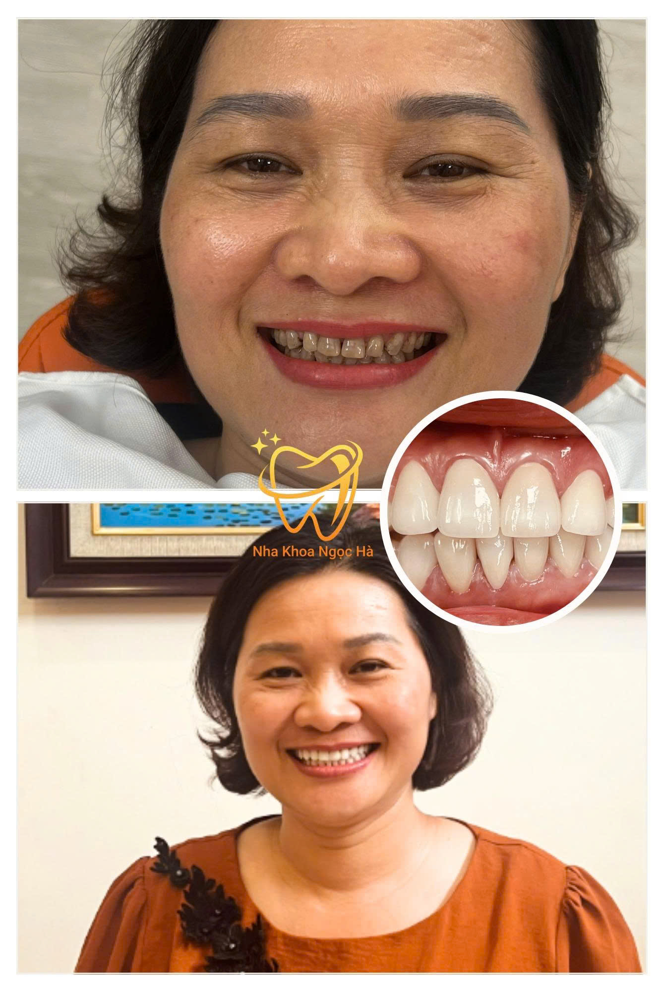 Nha khoa Ngọc Hà: Dịch vụ chuẩn quốc tế dành cho mọi người Việt Hàm răng mới của chị Hoài đều màu, trắng sáng, vừa vặn với khuôn mặt