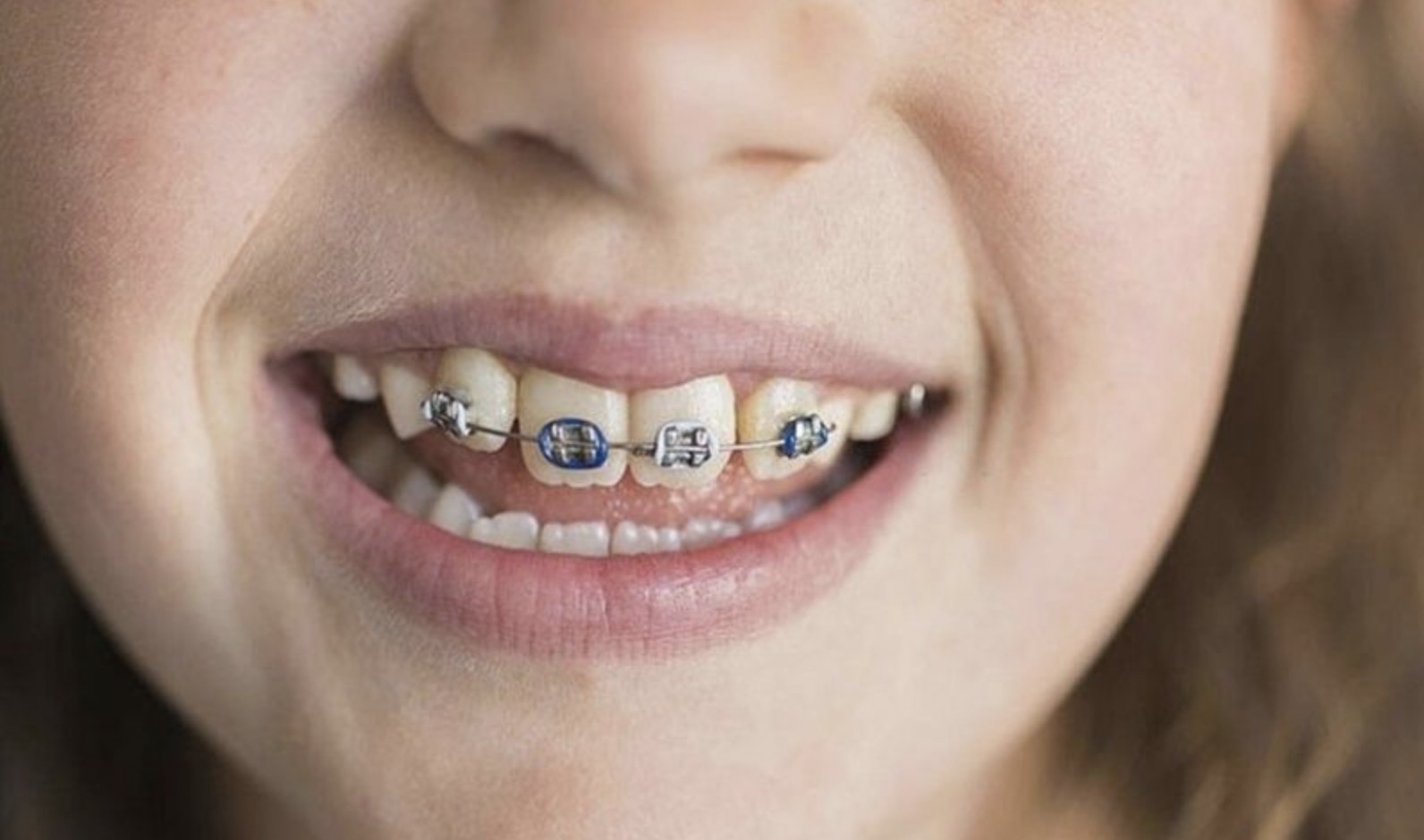 Niềng 4 răng cửa bao nhiêu tiền? Có cần niềng cả hàm? Niềng 4 răng cửa là chủ đề được nhiều người quan tâm khi nhóm răng này gặp các vấn đề như hô, móm hoặc mọc lệch