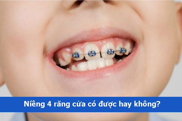 Niềng 4 răng cửa bao nhiêu tiền? Có cần niềng cả hàm? Niềng 4 răng cửa có nhiều mặt hạn chế nên không được khuyến khích sử dụng