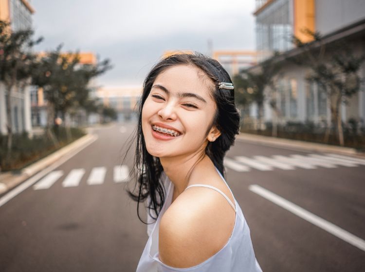 Tất tần tật những điều bạn cần biết về niềng răng 1 hàm Niềng răng mắc cài kim loại 1 hàm giúp người bệnh cải thiện tình trạng hô móm nhẹ