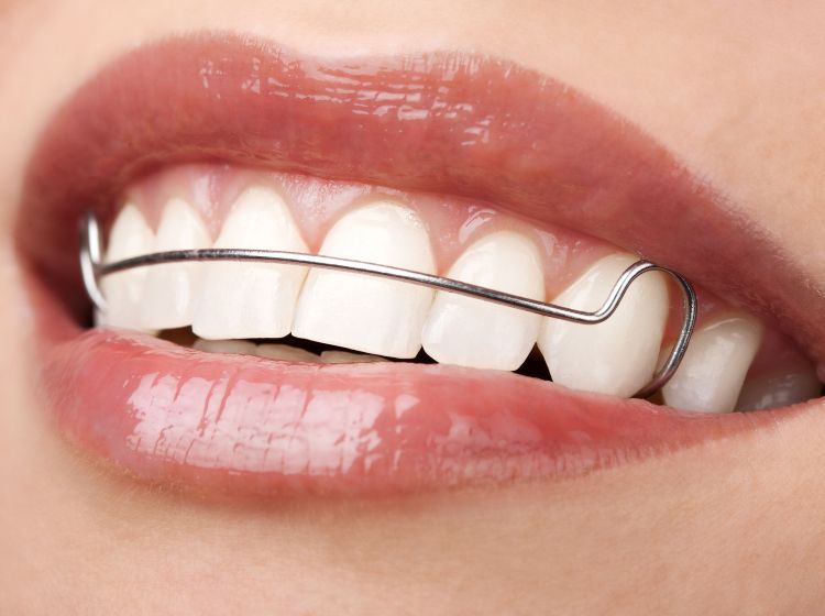 Tất tần tật những điều bạn cần biết về niềng răng 1 hàm Hàm duy trì giúp răng ổn định và không dịch chuyển về vị trí đầu