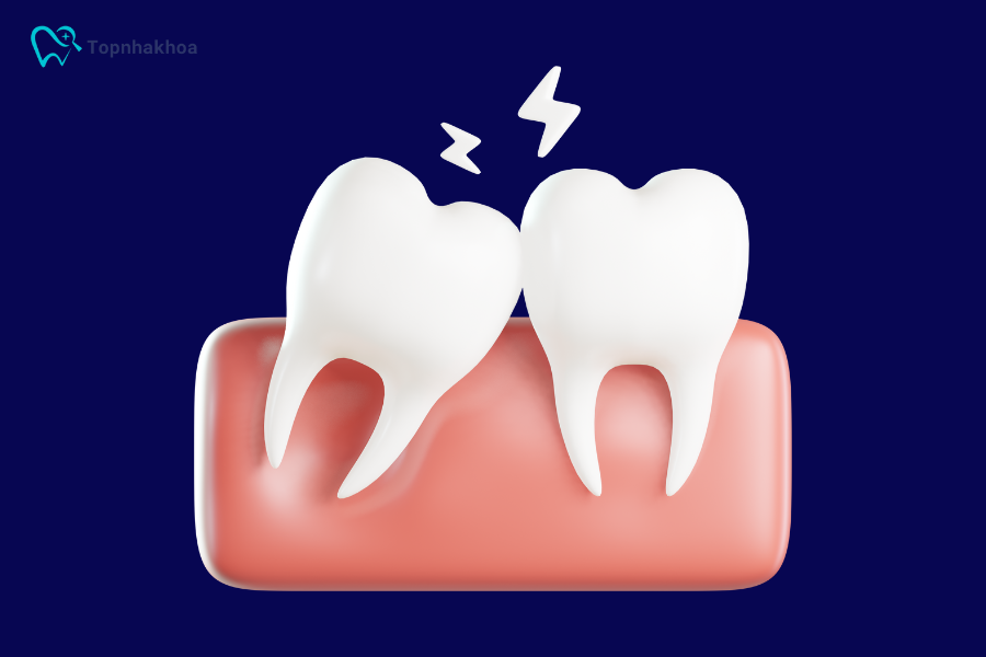Tình trạng răng lệch, xoay hoặc chen chúc cần can thiệp niềng răng để sắp xếp lại
