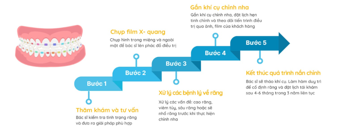 Tìm hiểu về niềng răng 2 hàm và những điều cần lưu ý Tuân thủ lộ trình niềng răng vừa rút ngắn thời gian vừa đảm bảo hiệu quả chỉnh nha