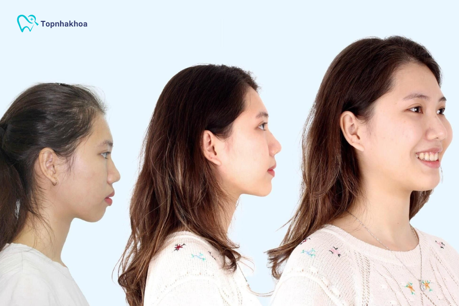 Niềng răng có giúp mũi cao hơn không? Những lưu ý khi niềng Thực tế, mũi cao hay thấp được quyết định bởi sự phát triển của xương và sụn mũi