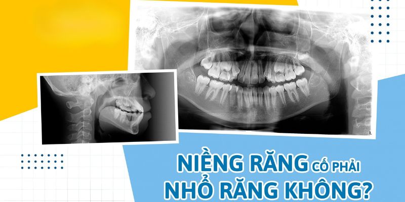 Niềng răng có phải nhổ răng không được rất nhiều người quan tâm trước khi quyết định chỉnh nha