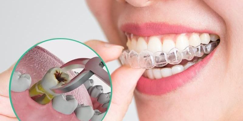 Răng bị hư tổn, sâu nặng cần loại bỏ trước khi niềng