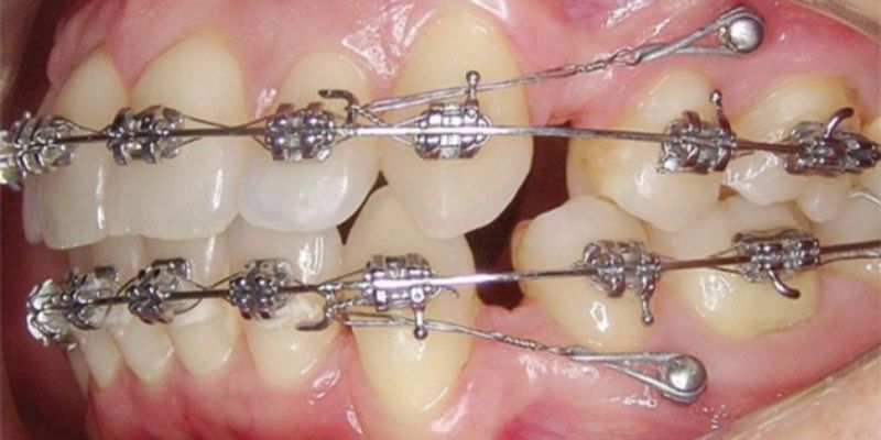 Mini vít thường được sử dụng trong các ca cần kéo lùi răng cửa