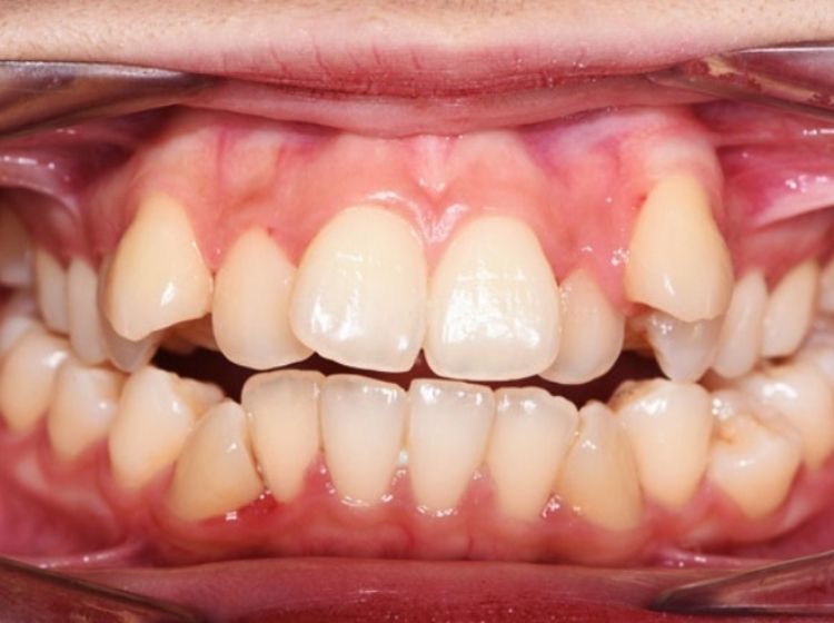 Răng mọc chen chúc vào nhau khiến răng chìa ra ngoài và gây hô
