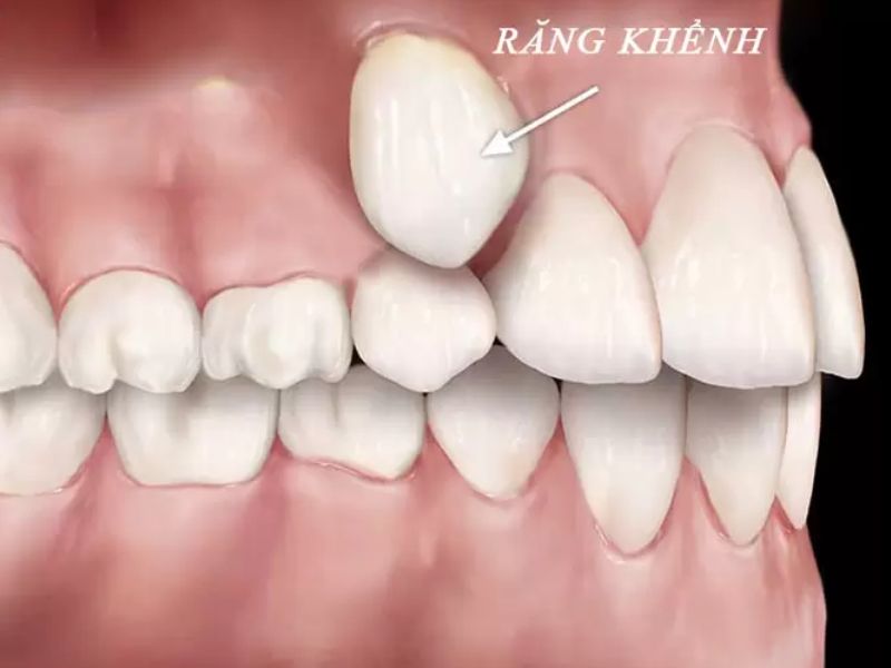 Trước khi niềng phải đánh giá kỹ lưỡng về cấu trúc hàm, vị trí răng và mong muốn từng bệnh nhân