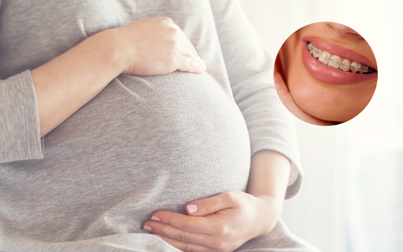 Niềng răng khi mang thai là vấn đề nhiều chị em quan tâm hiện nay