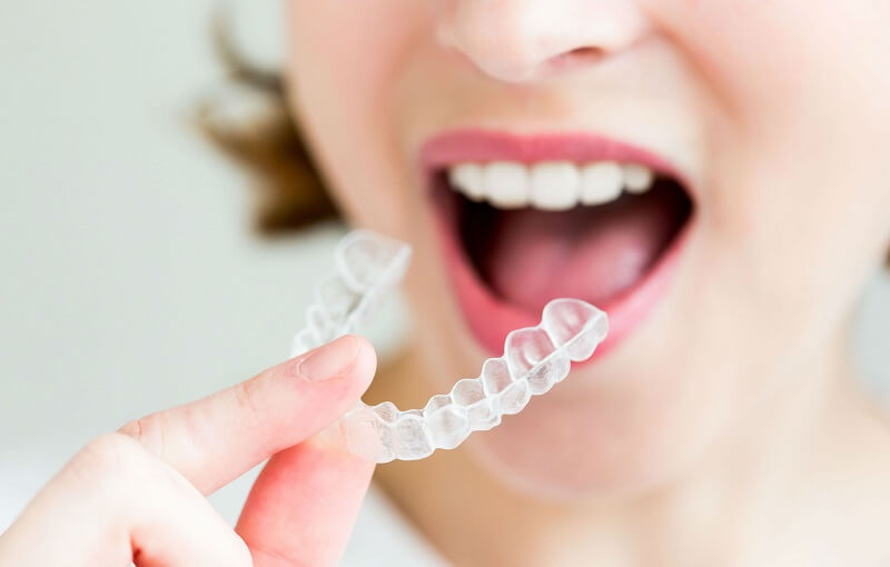 Nên tạm tháo mắc cài, đeo hàm duy trì trong 3 tháng đầu và 3 tháng cuối thai kỳ