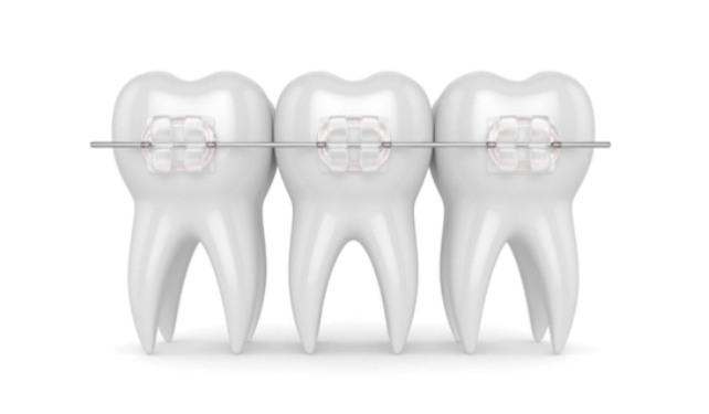 Là phiên bản nâng cấp của mắc cài sứ, pha lê trong suốt cho cảm giác gần như “vô hình”