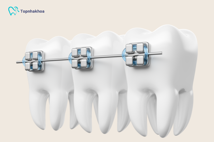 Tổng hợp các phương pháp niềng răng tại nhà hiệu quả Cách này thường được xem là “bản thô” của mắc cài cố định