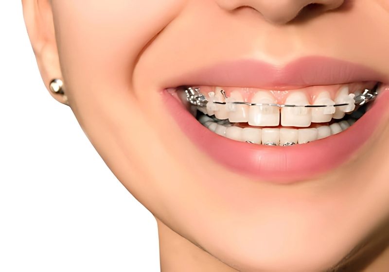 Niềng răng thưa giúp khép kín khoảng hở, mang lại nụ cười đều đẹp và tự tin hơn