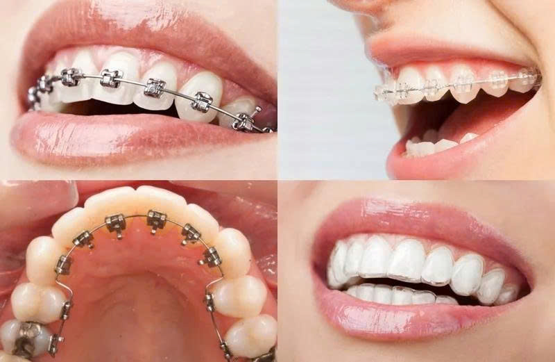 Niềng răng được chia thành nhiều mức giá khác nhau, phụ thuộc vào chất liệu mắc cài