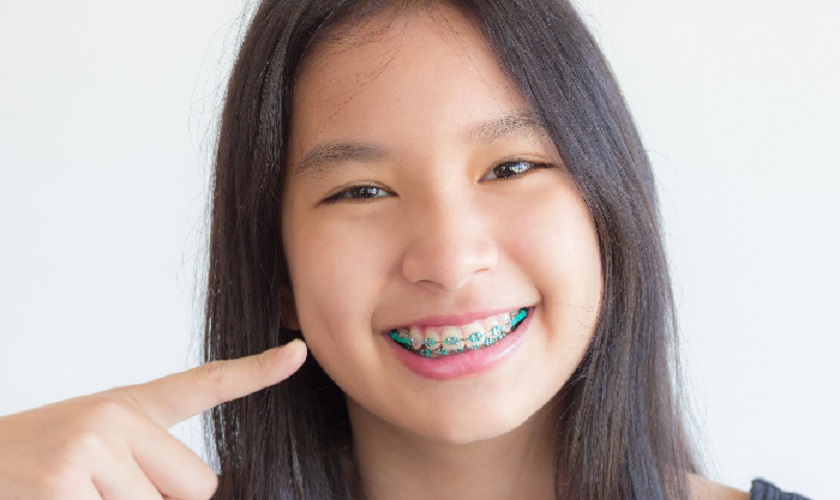 Niềng răng trẻ em ngày càng được bố mẹ quan tâm để đem đến nụ cười tự tin cho bé 