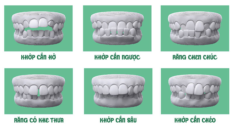 Bố mẹ nên đưa trẻ đi khám chỉnh nha khi phát hiện các dấu hiệu răng miệng bất thường