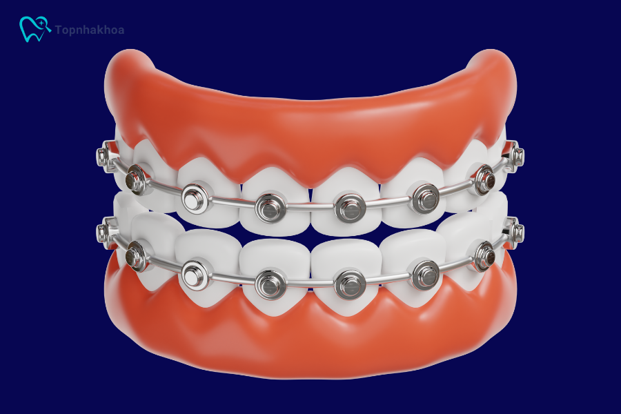 Niềng răng là phương pháp chỉnh nha sử dụng hệ thống mắc cài, dây cung hoặc khay trong suốt để dịch chuyển răng về vị trí mong muốn