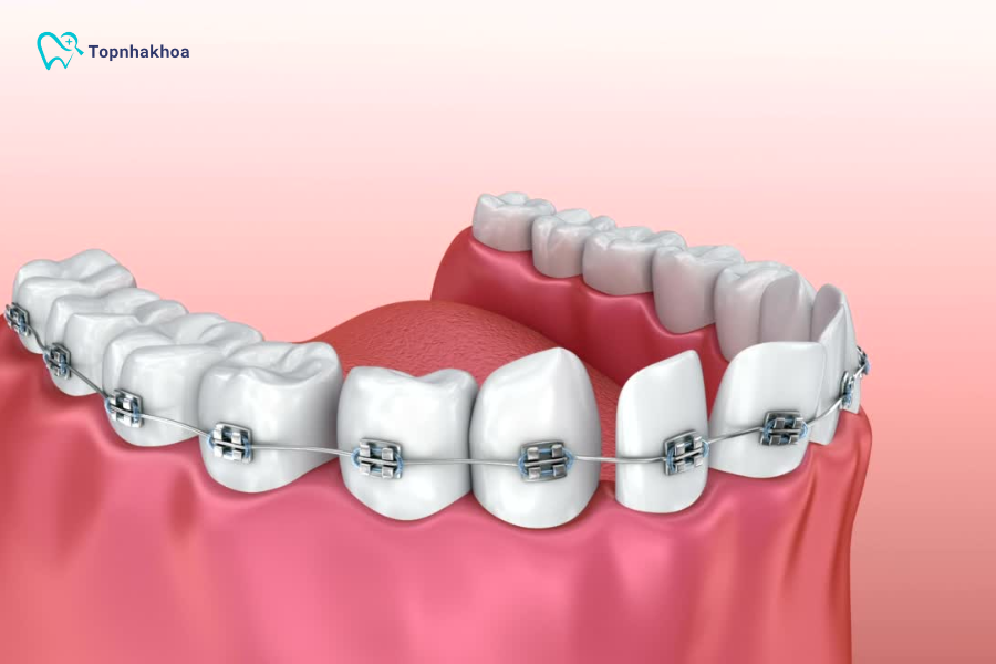 Răng giả có niềng được không? Cách xử lý khi muốn chỉnh nha Trên thực tế, câu trả lời phụ thuộc vào loại răng giả, số lượng răng đã làm, tình trạng răng miệng và kế hoạch điều trị cụ thể của bác sĩ
