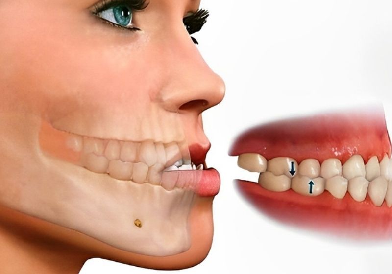 Răng móm có niềng được không? Giải đáp chi tiết nhất Tình trạng móm răng xuất phát từ nhiều nguyên nhân khác nhau