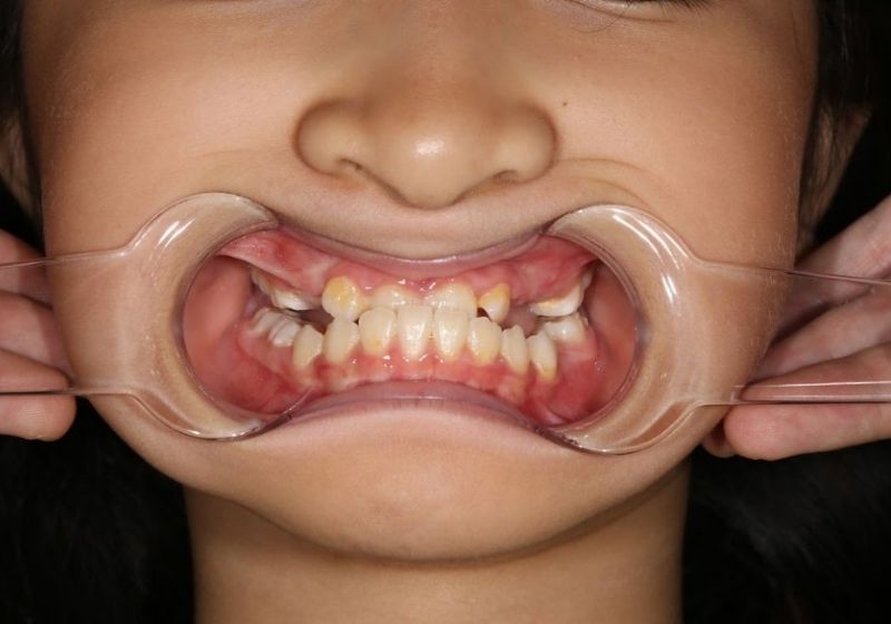 Răng móm có niềng được không? Giải đáp chi tiết nhất Móm do răng là tình trạng sai khớp cắn gây ra bởi răng mọc lệch