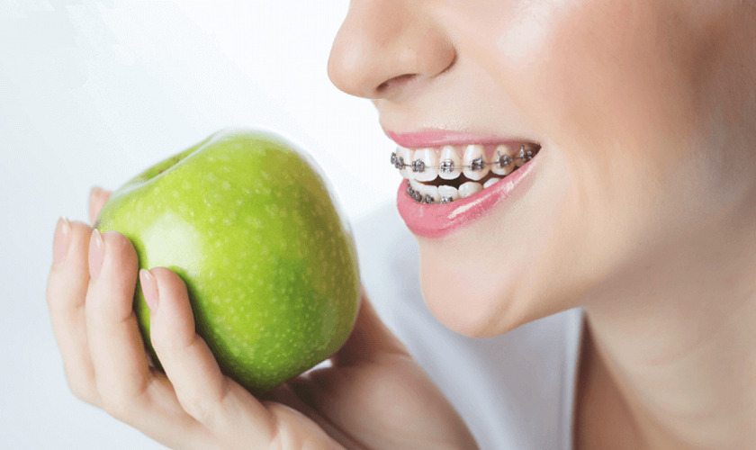 Thực đơn niềng răng cần đảm bảo dinh dưỡng và không gây khó chịu cho răng