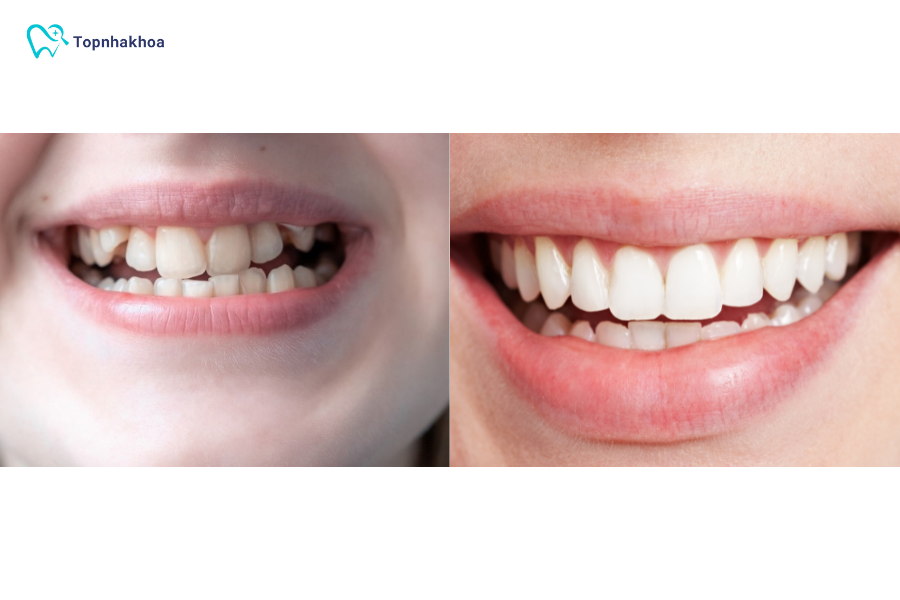 Khi khớp cắn được điều chỉnh chuẩn, các triệu chứng này thường giảm rõ rệt