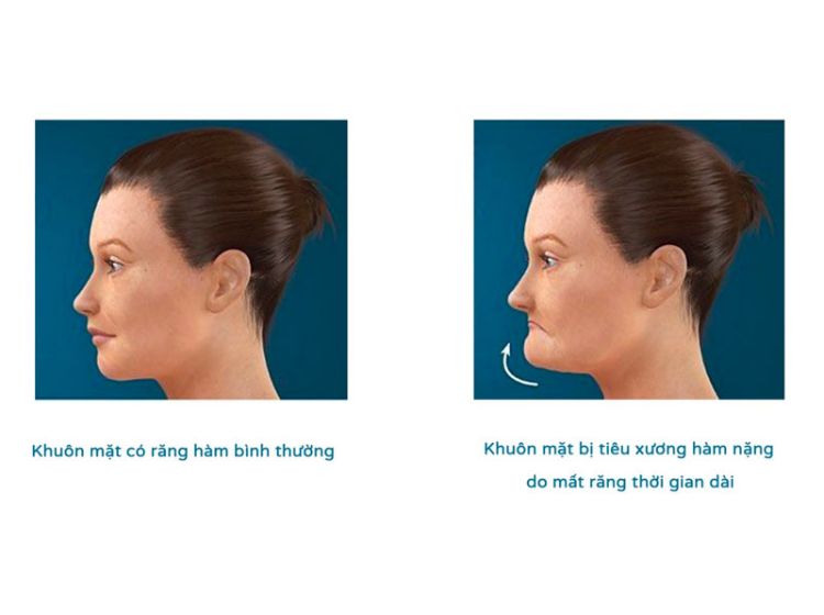 Giải đáp thắc mắc: Xương hàm mỏng có niềng răng được không? Hiểu về xương hàm mỏng giúp người bệnh lựa chọn phương án niềng răng phù hợp