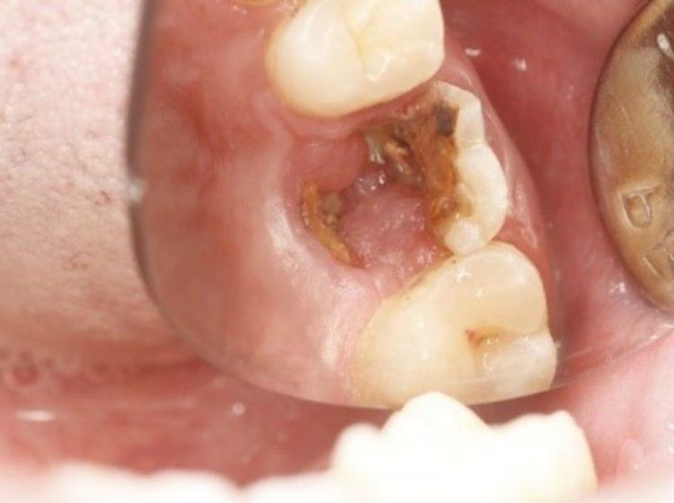 Giải đáp thắc mắc: Xương hàm mỏng có niềng răng được không? Vi khuẩn phá hủy chân răng khiến xương hàm dần tiêu biến