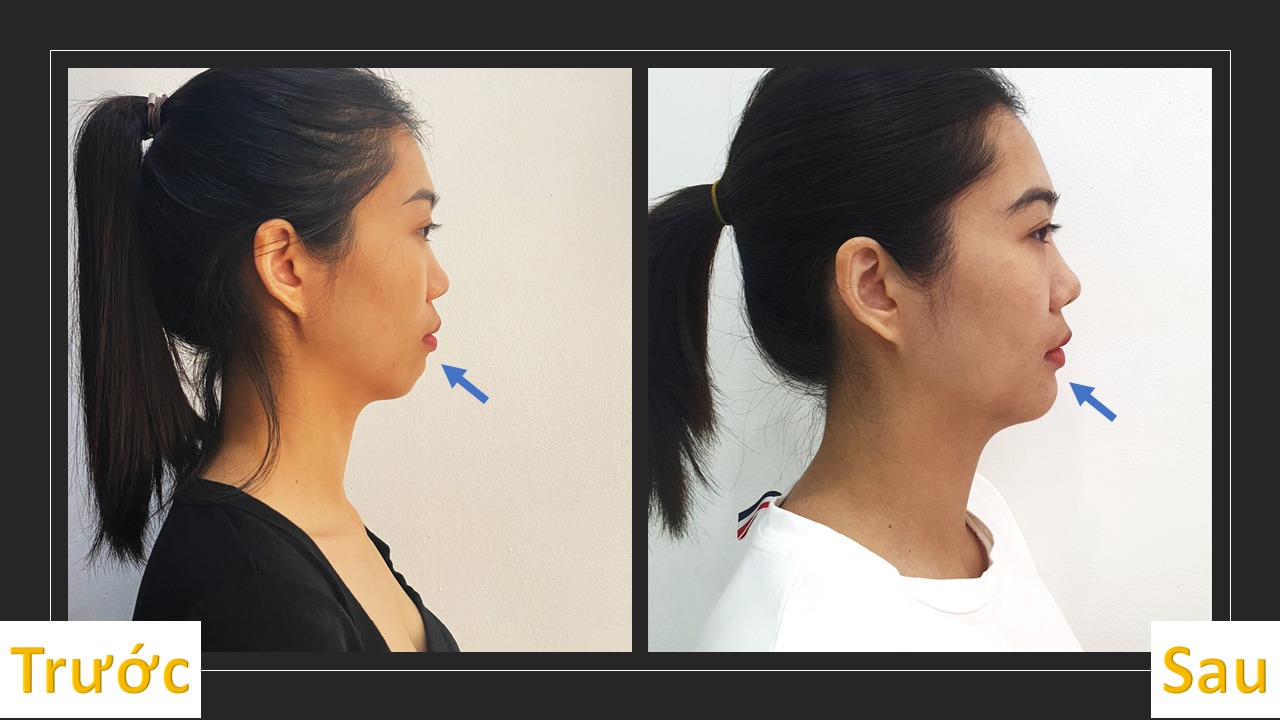 Nha khoa Nụ Cười Vĩnh Phúc: Địa chỉ uy tín hơn 20.000 khách hàng tin chọn Niềng răng không chỉ giúp người bệnh cải thiện về mặt thẩm mỹ mà còn thay đổi khớp cắn