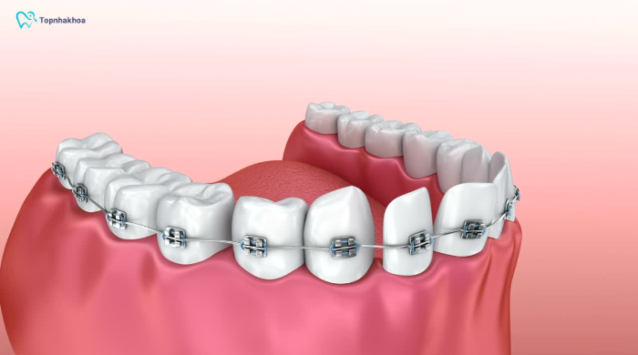 Khoảng 35% thanh thiếu niên châu Á đang có nhu cầu niềng răng, trong đó tỷ lệ lựa chọn mắc cài kim loại chiếm cao nhất vì chi phí phù hợp