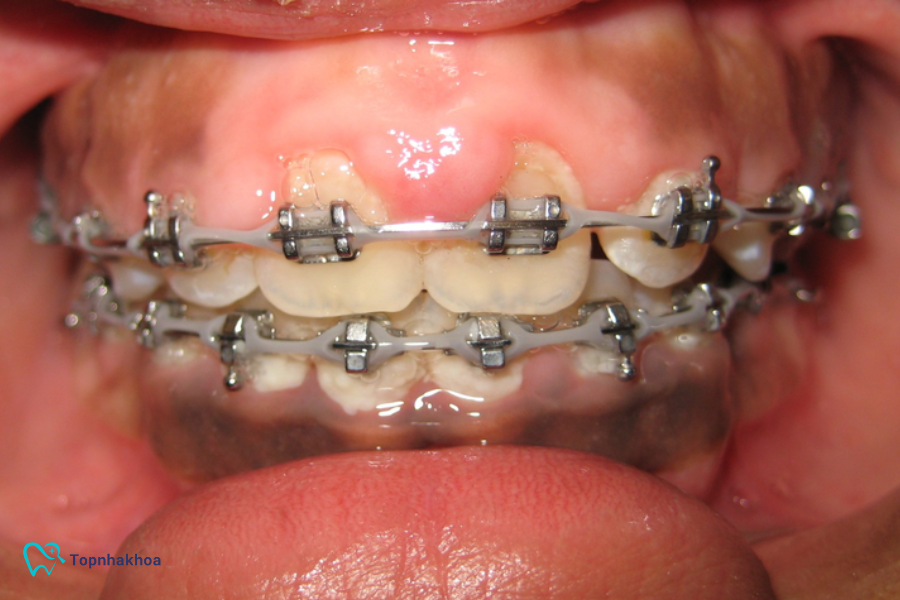 Lợi trùm khi niềng răng là gì? Nguyên nhân và cách phòng ngừa Nếu không xử lý sớm, tình trạng trùm lợi có thể kéo dài, làm tăng nguy cơ bệnh lý răng miệng