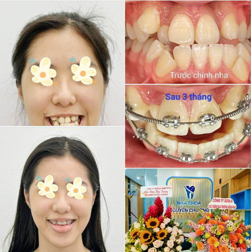 Nha khoa Nguyên Chương nổi tiếng bởi dịch vụ uy tín với giá tốt Chị Thu Trang đã thấy rõ sự thay đổi tích cực trên hàm răng của mình sau 3 tháng bắt đầu hành trình niềng răng