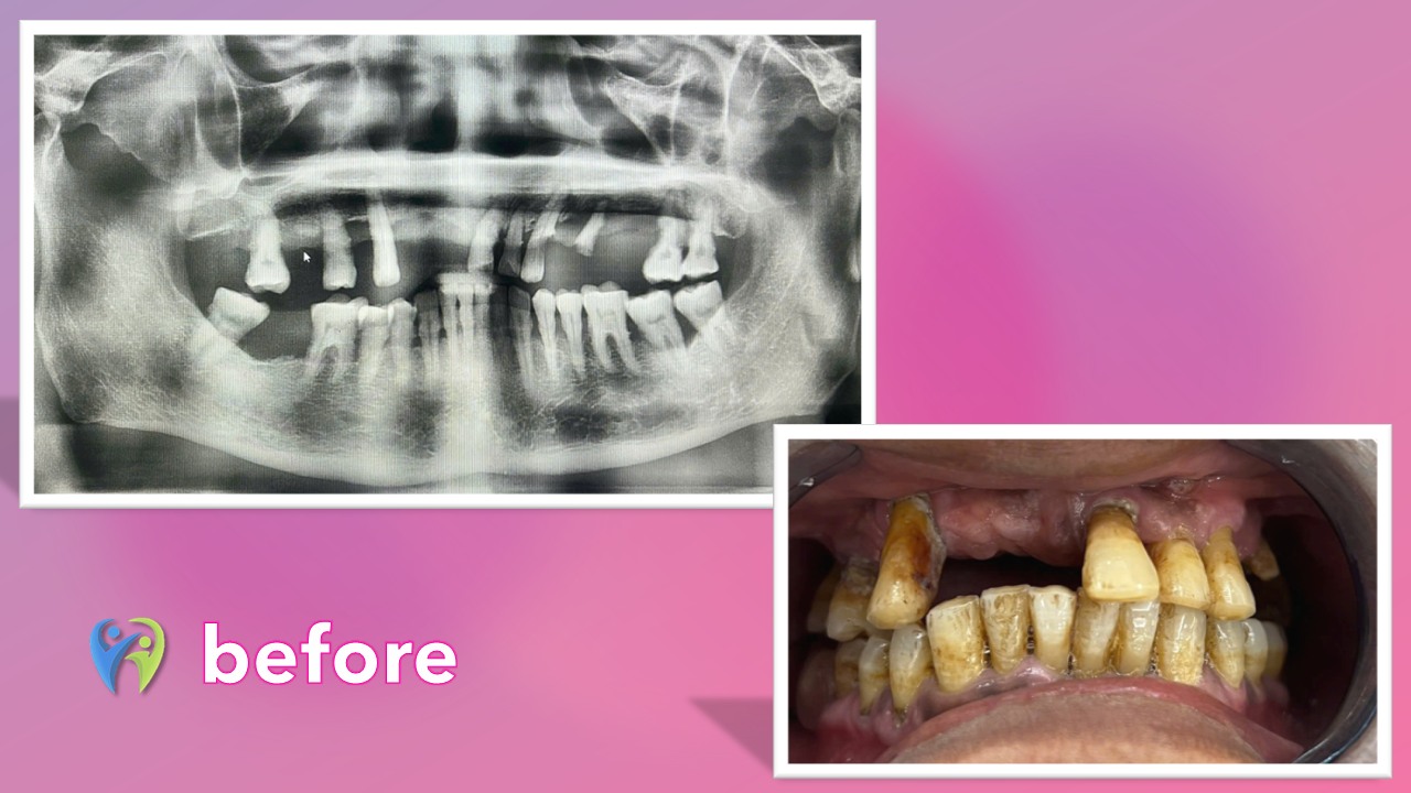 Nha khoa Ninh Hiệp: Địa chỉ được người dân Vĩnh Phúc tin tưởng Tình trạng hàm trên bị sâu, hỏng nặng của chú Nguyễn Văn An (65 tuổi, Vĩnh Tường, Vĩnh Phúc)