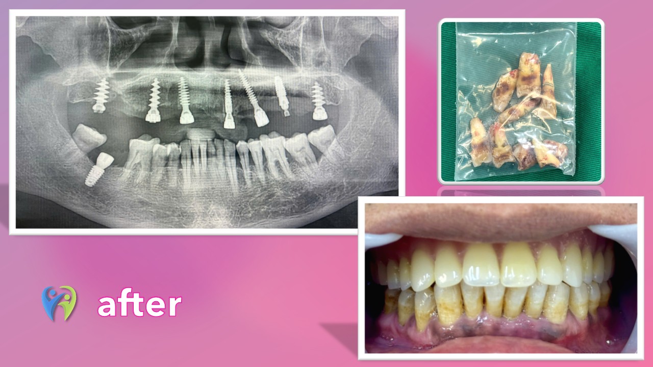 Nha khoa Ninh Hiệp: Địa chỉ được người dân Vĩnh Phúc tin tưởng Hình ảnh X-quang chụp sau phẫu thuật với 8 trụ Implant được cấy ghép vững chắc