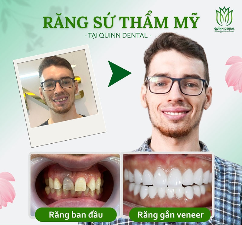 Nha khoa QUINN Dental: Nơi nụ cười tỏa sáng như kim cương Anh Jack sở hữu ngay một nụ cười mới tự nhiên và hài hòa sau điều trị