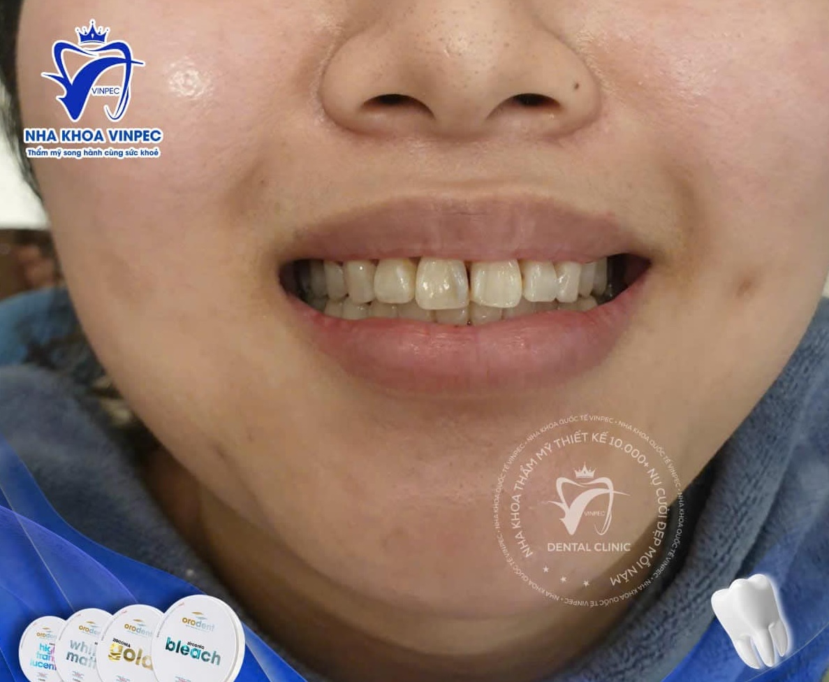 Nha khoa RHM Vinpec: Giải pháp chăm sóc răng miệng toàn diện Tình trạng răng ố vàng, xỉn màu trước đó của chị Mai