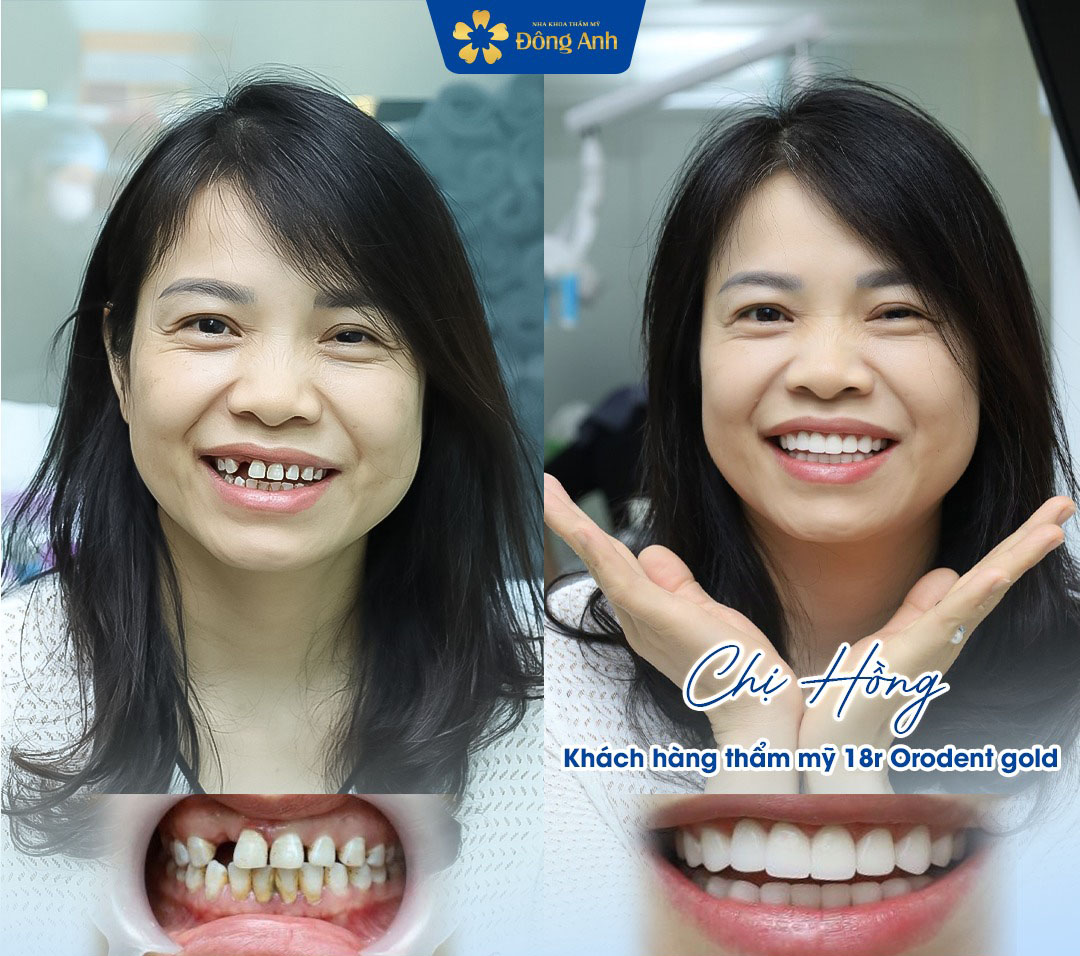 Hàm răng của chị Hồng giờ đây đều tăm tắp, trắng sáng tự nhiên