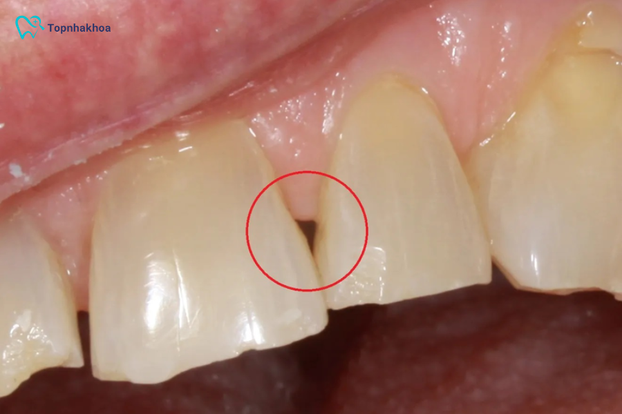 Tam giác đen khi niềng răng là tình trạng nhiều người gặp phải sau khi chỉnh nha, gây mất thẩm mỹ, khó chịu khi ăn uống và tiềm ẩn nguy cơ bệnh lý