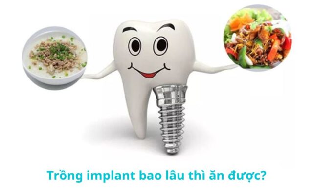 Trồng implant bao lâu thì ăn được, liệu có phải kiêng khem quá lâu và cần lưu ý gì trong chế độ ăn uống để vết thương nhanh lành