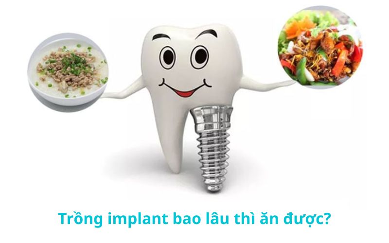 Trồng implant bao lâu thì ăn được, liệu có phải kiêng khem quá lâu và cần lưu ý gì trong chế độ ăn uống để vết thương nhanh lành