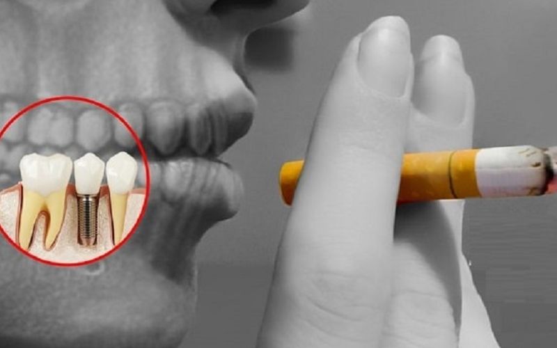Người trồng răng hút thuốc lá sẽ ức chế quá trình tái tạo xương và kéo dài thời gian hồi phục