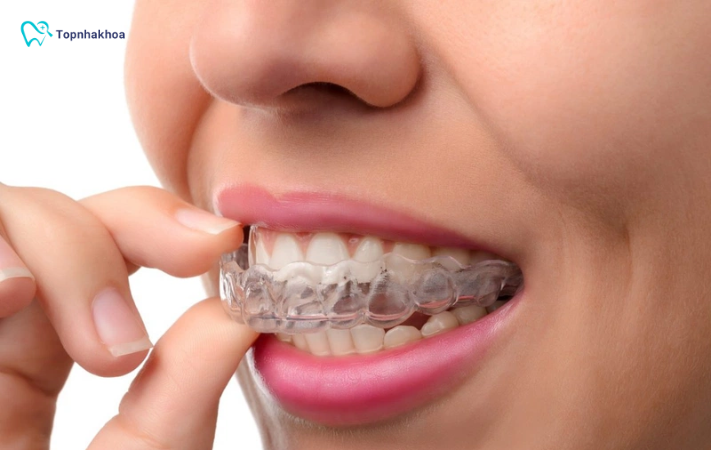 Tổng hợp các dụng cụ cơ bản trong chỉnh nha cần thiết nhất Sau khi tháo niềng, răng vẫn có xu hướng “chạy” về vị trí cũ. Lúc này, hàm duy trì đóng vai trò giữ răng ổn định trong giai đoạn hậu chỉnh nha